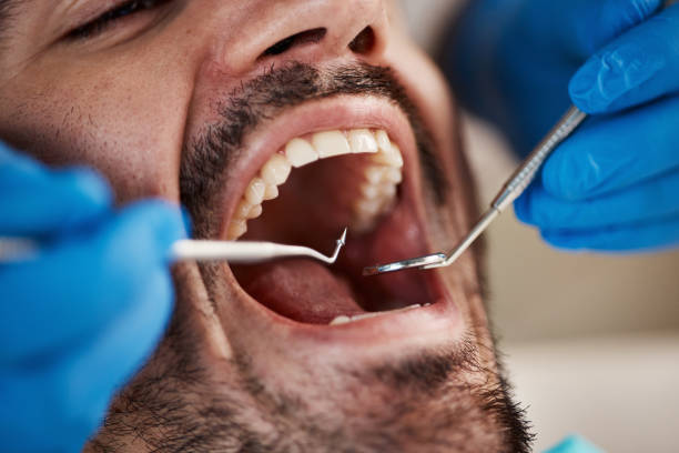 Best Emergency Dental Extractions in Scaggsville, MD